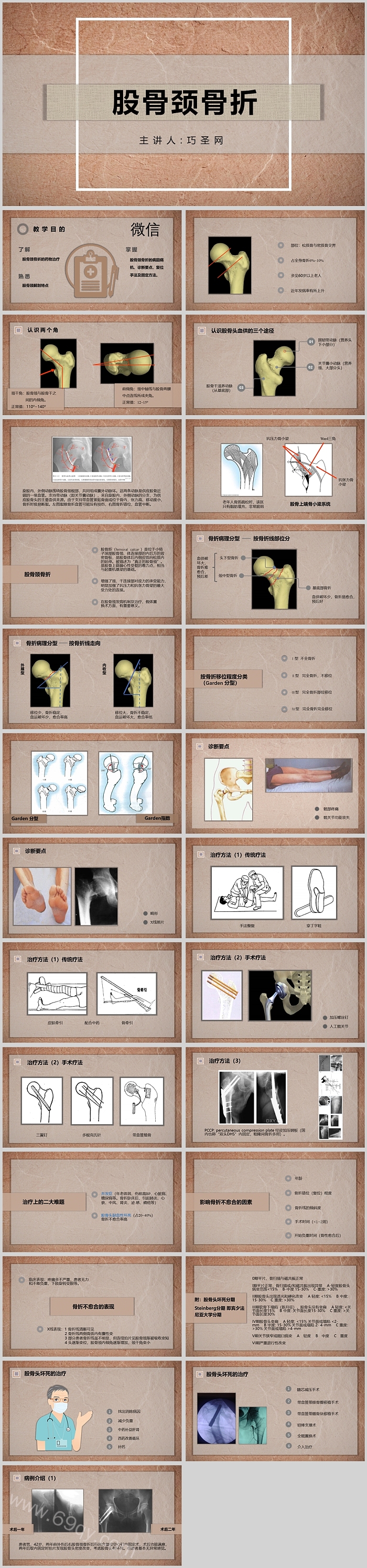 复古风股骨颈骨折的护理查房PPT模板