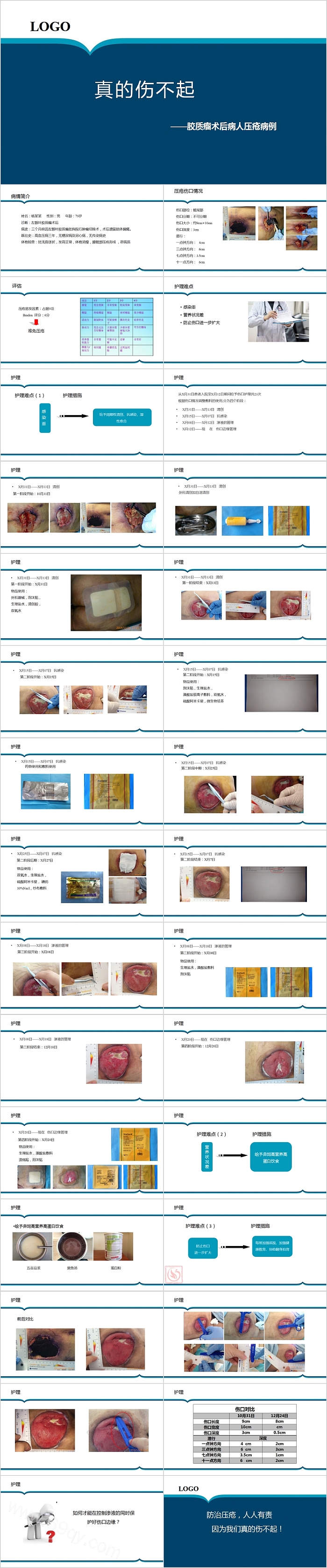 胶质瘤术后病人压疮病例PPT模板